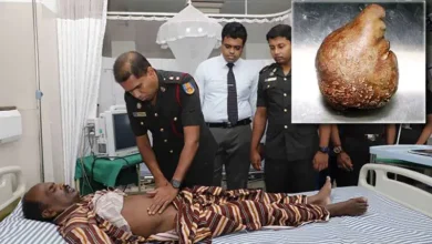 Sri Lanka'da bir hastadan 3,1 kilogram ağırlığında mesane taşı çıkarıldı