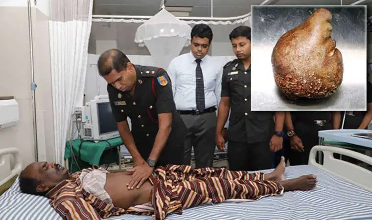 Sri Lanka'da bir hastadan 3,1 kilogram ağırlığında mesane taşı çıkarıldı