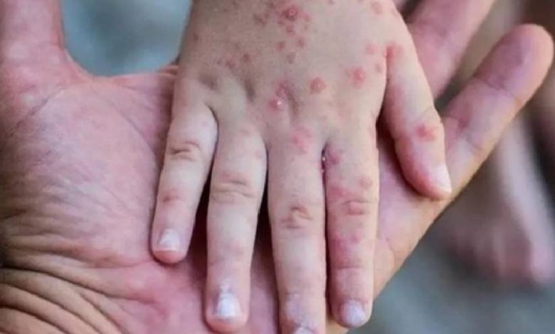 Güney Afrika’da son 5 haftada 13 M çiçeği vakası kaydedildi